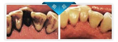 洁牙前后对比图